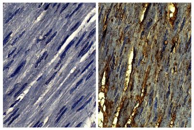Paraffin embedded human gastric cancer tissue was stained with Goat IgG-UNLB isotype control (SB Cat. No. 0109-01; left) and Goat Anti-Type VI Collagen-UNLB (SB Cat. No. 1360-01; right) followed by Swine Anti-Goat IgG(H+L), Human/Rat/Mouse SP ads-BIOT (SB Cat. No. 6300-08), Streptavidin-HRP (SB Cat. No. 7100-05), DAB, and hematoxylin.
