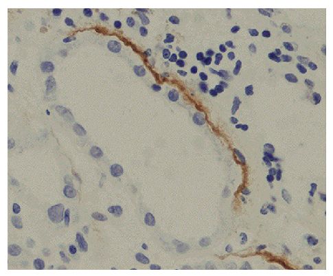 Paraffin embedded tubular basement membrane tissue section from patients with Anti-GBM disease was stained with Mouse Anti-Human IgG<sub>3</sub> Hinge-UNLB (SB Cat. No. 9210-01) followed by an HRP conjugated secondary antibody and DAB.<br/>Image from Qu Z