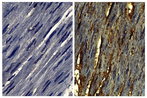 Paraffin embedded human gastric cancer tissue was stained with Goat IgG-UNLB isotype control (SB Cat. No. 0109-01; left) and Goat Anti-Type VI Collagen-UNLB (SB Cat. No. 1360-01; right) followed by Swine Anti-Goat IgG(H+L), Human/Rat/Mouse SP ads-BIOT (SB