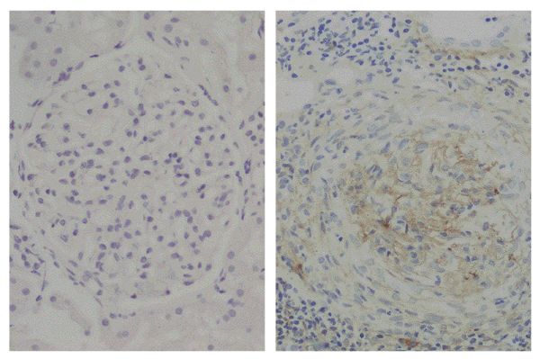 Paraffin embedded glomerular basement membrane tissue sections from patients with Anti-GBM disease were stained with Mouse Anti-Human IgG<sub>2</sub> Fd-UNLB (SB Cat. No. 9080-01; right) followed by an HRP conjugated secondary antibody and DAB.<br/>Images