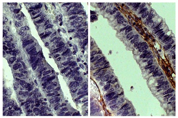 Paraffin embedded human gastric cancer tissue was stained with Goat IgG-UNLB isotype control (SB Cat. No. 0109-01; left) and Goat Anti-Type III Collagen-UNLB (SB Cat. No. 1330-01; right) followed by Swine Anti-Goat IgG(H+L), Human/Rat/Mouse SP ads-HRP (SB