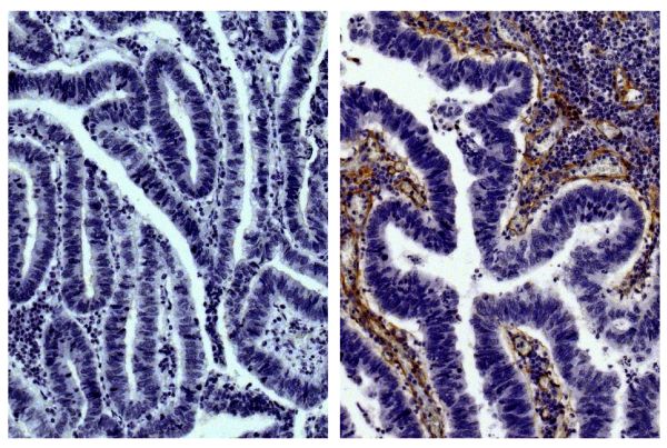 Paraffin embedded human gastric cancer tissue was stained with Goat IgG-UNLB isotype control (SB Cat. No. 0109-01; left) and Goat Anti-Type IV Collagen-UNLB (SB Cat. No. 1340-01; right) followed by Swine Anti-Goat IgG(H+L), Human/Rat/Mouse SP ads-HRP (SB 