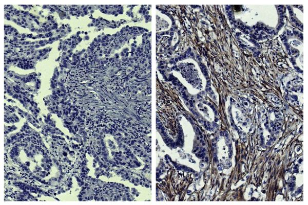 Paraffin embedded human gastric cancer tissue was stained with Mouse IgG<sub>1</sub>-UNLB isotype control (SB Cat. No. 0102-01; left) and Mouse Anti-Human MMP-2-UNLB (SB Cat. No. 12015-01; right) followed by HRP conjugated Anti-Mouse Ig secondary antibody