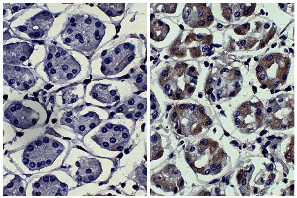 Paraffin embedded human kidney cancer tissue was stained with Mouse IgG<sub>2a</sub>-UNLB isotype control (SB Cat. No. 0103-01; left) and Mouse Anti-Human MMP-3-UNLB (SB Cat. No. 12020-01; right) followed by Goat Anti-Mouse IgG<sub>2a</sub>, Human ads-HRP