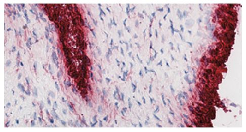 Frozen human synovial tissue section from patient with osteoarthritis was stained with hematoxylin and eosin and Mouse Anti-Human CD55-UNLB (SB Cat. No. 9661-01) followed by a secondary antibody and colorimetric substrate.<br/>Image from Mucke J, Hoyer A,