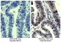 Paraffin embedded human gastric cancer tissue was stained with Mouse Anti-Acetyl-Histone H4 (Lys12)-UNLB (SB Cat. No. 13400-01) followed by Goat Anti-Mouse IgG(H+L), Human ads-HRP (SB Cat. No. 1031-05), DAB, and hematoxylin.