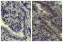 Paraffin embedded human gastric cancer tissue was stained with Mouse IgG-UNLB isotype control (SB Cat. No. 0107-01; left) and Mouse Anti-Human EGFR-UNLB (SB Cat. No. 10400-01; right) followed by an HRP conjugated anti-mouse IgG secondary antibody, DAB, an