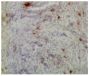 Frozen chicken ovarian tumor section was stained with Mouse Anti-Chicken CD8α-UNLB (SB Cat. No. 8220-01) followed by an HRP conjugated secondary antibody, DAB, and hematoxylin.<br/>Image from Bradaric MJ, Barua A, Penumatsa K, Yi Y, Edassery SL, Sharma S,