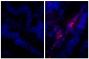 Paraffin embedded human gastric cancer tissue was stained with Rabbit IgG-UNLB isotype control (SB Cat. No. 0111-01; left) and Rabbit Anti-Human IgG(H+L), Mouse ads-UNLB (SB Cat. No. 6145-01; right) followed by Donkey Anti-Rabbit IgG(H+L), Mouse/Rat/Human